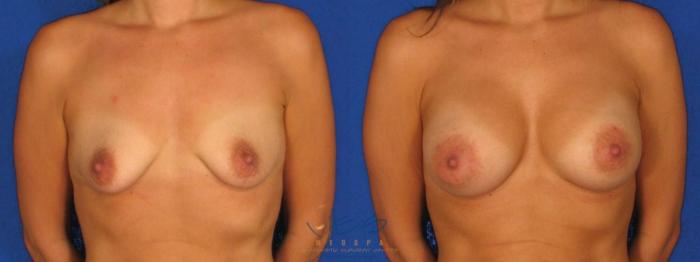 Before & After Breast Augmentation Case 27 Front View in Vancouver, BC