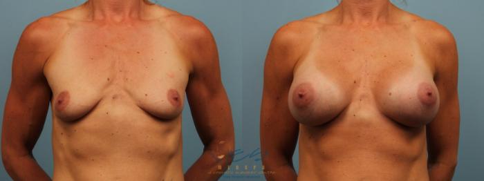 Before & After Breast Augmentation Case 273 Front View in Vancouver, BC