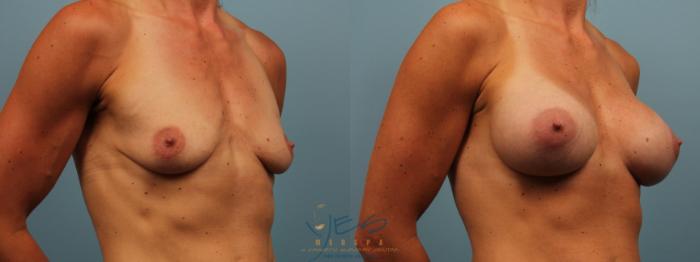 Before & After Breast Augmentation Case 273 Right Oblique View in Vancouver, BC
