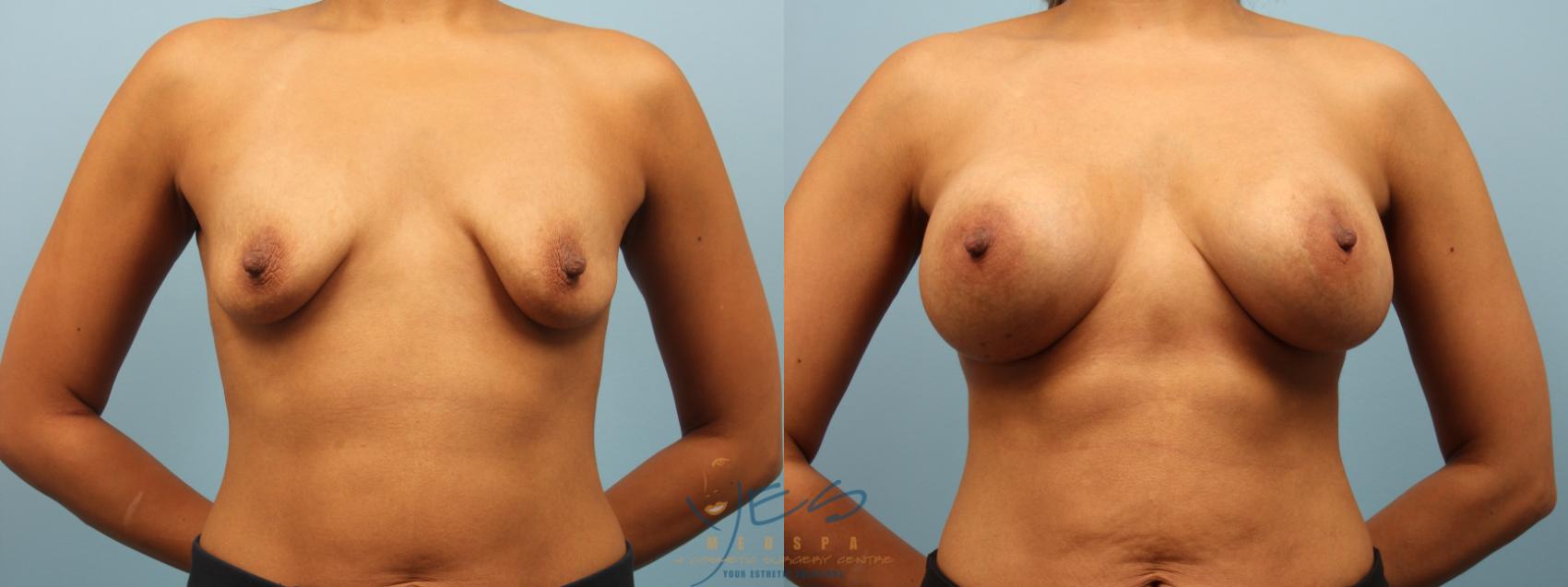 Before & After Breast Augmentation Case 278 Front View in Vancouver, BC