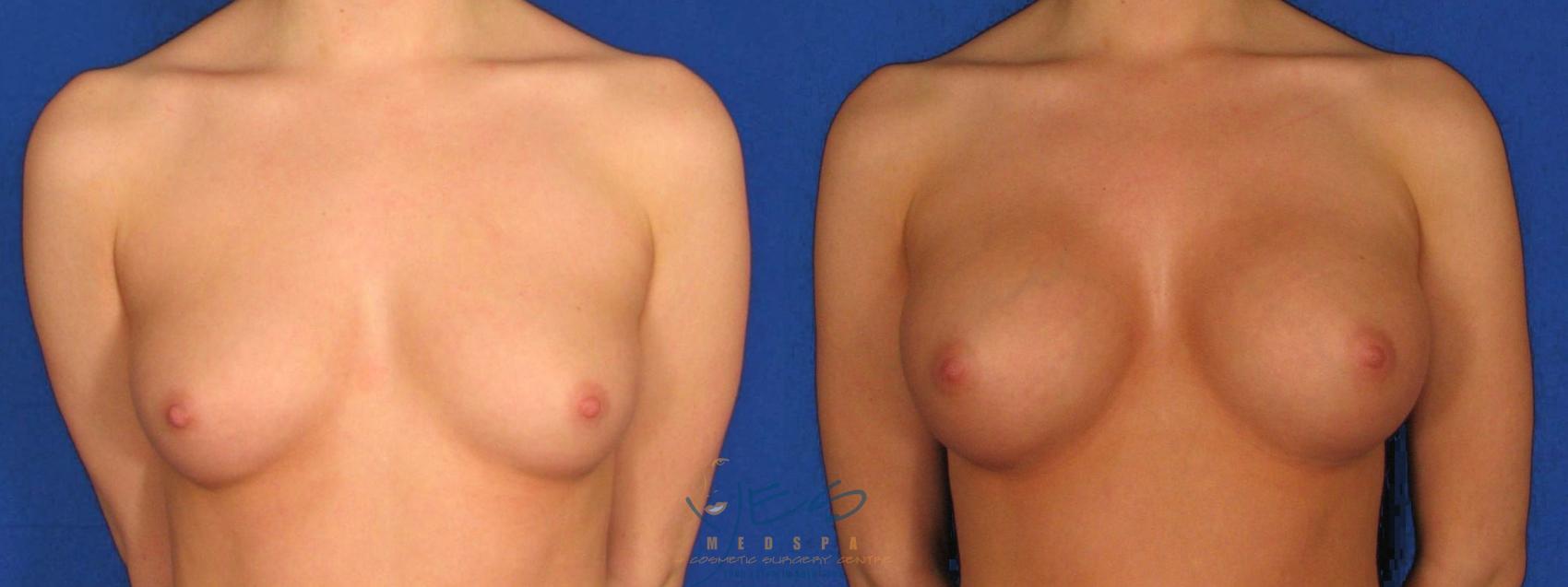 Before & After Breast Augmentation Case 28 Front View in Vancouver, BC
