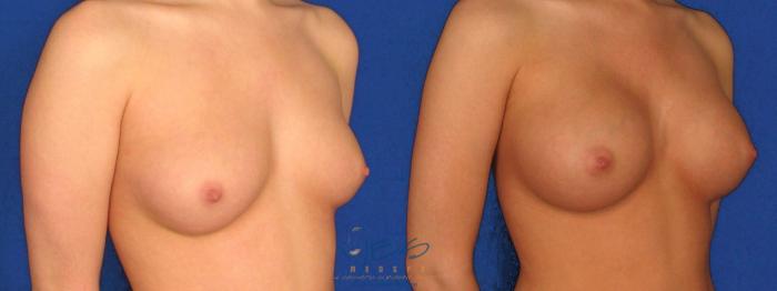 Before & After Breast Augmentation Case 28 Right Oblique View in Vancouver, BC