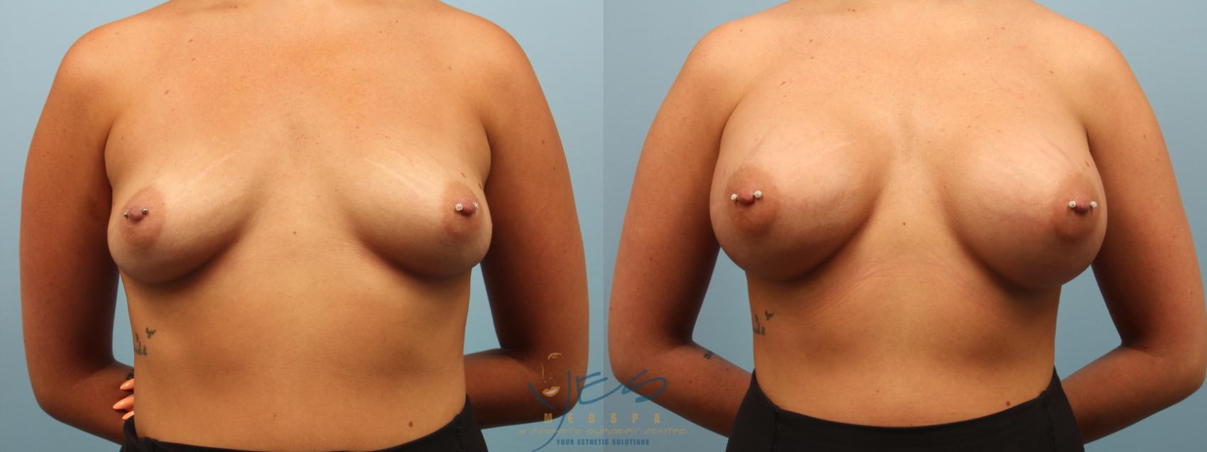 Before & After Breast Augmentation Case 282 Front View in Vancouver, BC