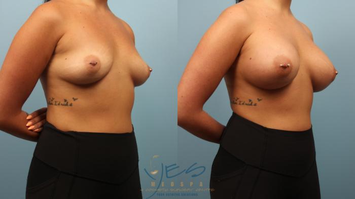 Before & After Breast Augmentation Case 282 Right Oblique View in Vancouver, BC