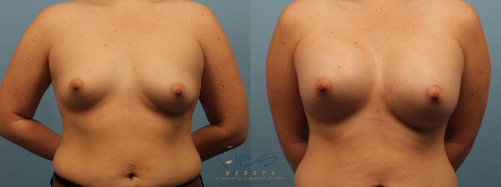 Before & After Breast Augmentation Case 284 Front View in Vancouver, BC
