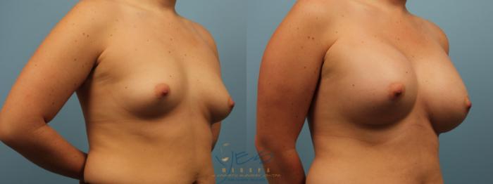 Before & After Breast Augmentation Case 284 Right Oblique View in Vancouver, BC