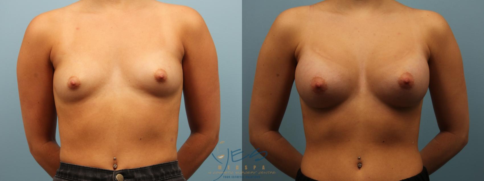 Before & After Breast Augmentation Case 285 Front View in Vancouver, BC