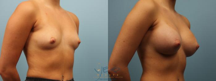 Before & After Breast Augmentation Case 285 Right Oblique View in Vancouver, BC