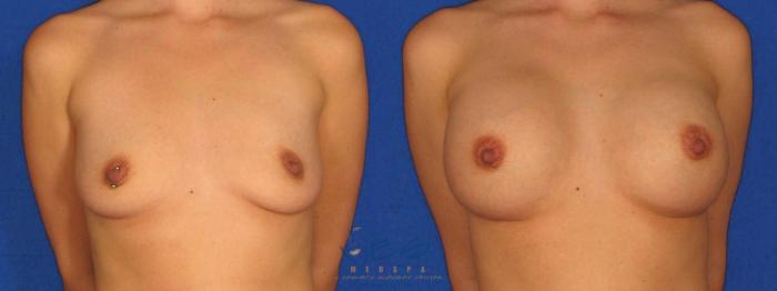 Before & After Breast Augmentation Case 29 Front View in Vancouver, BC