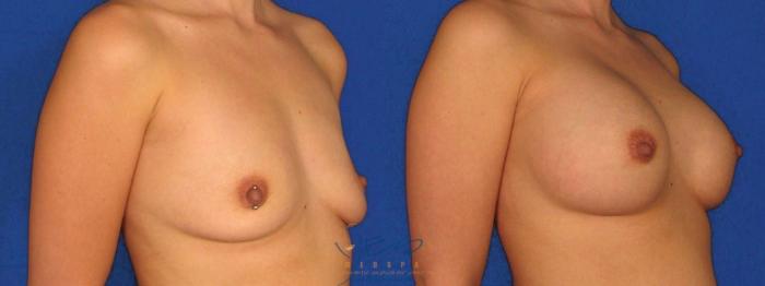 Before & After Breast Augmentation Case 29 Right Oblique View in Vancouver, BC
