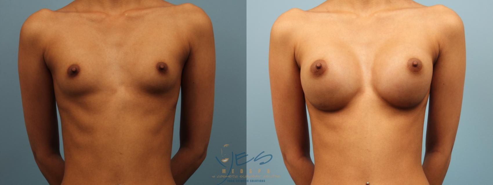 Before & After Breast Augmentation Case 298 Front View in Vancouver, BC