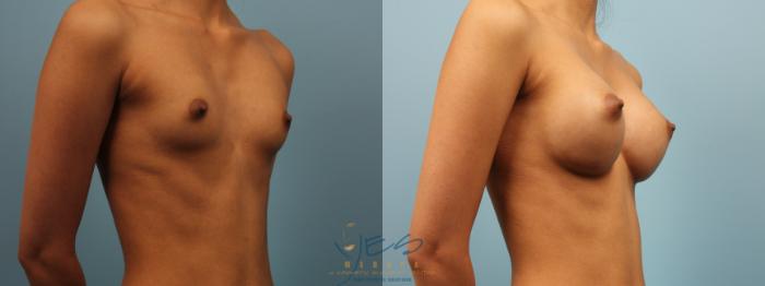 Before & After Breast Augmentation Case 298 Right Oblique View in Vancouver, BC