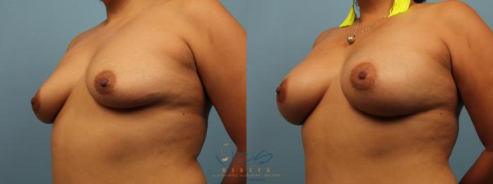Before & After Breast Augmentation Case 312 Left Oblique View in Vancouver, BC