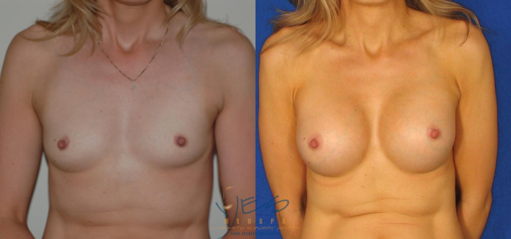 Before & After Breast Augmentation Case 34 View #1 View in Vancouver, BC