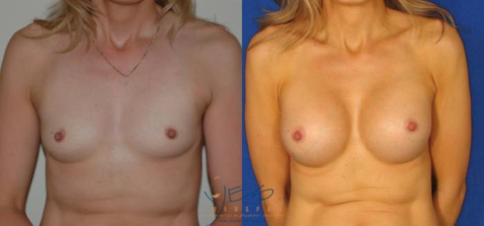 Before & After Breast Augmentation Case 34 View #1 View in Vancouver, BC