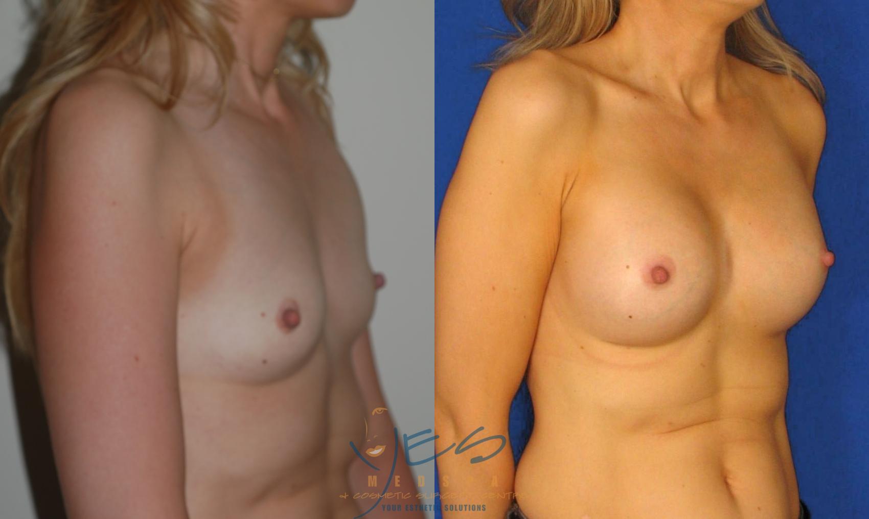 Before & After Breast Augmentation Case 34 View #2 View in Vancouver, BC