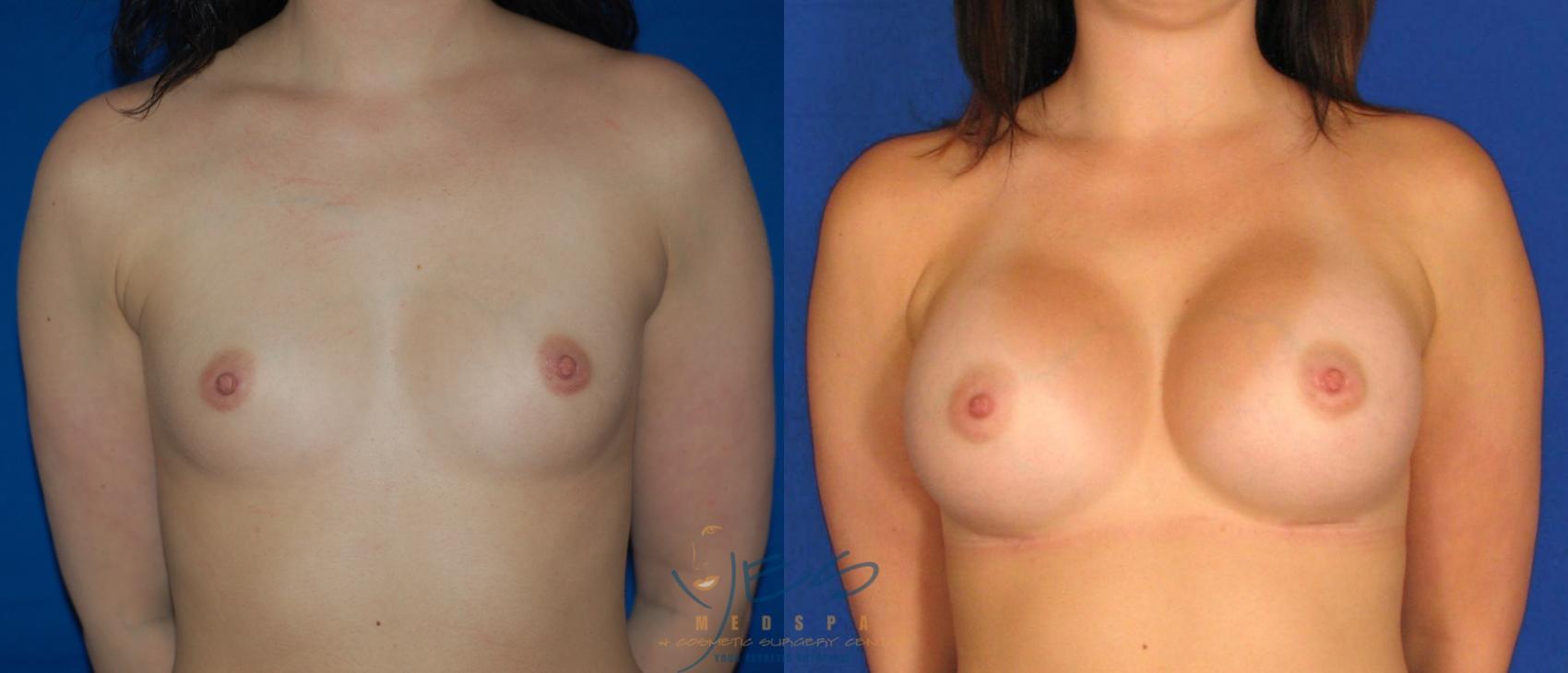 Before & After Breast Augmentation Case 35 View #1 View in Vancouver, BC