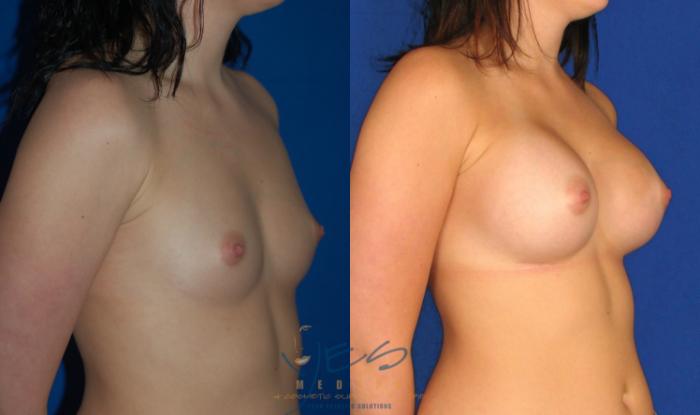 Before & After Breast Augmentation Case 35 View #2 View in Vancouver, BC