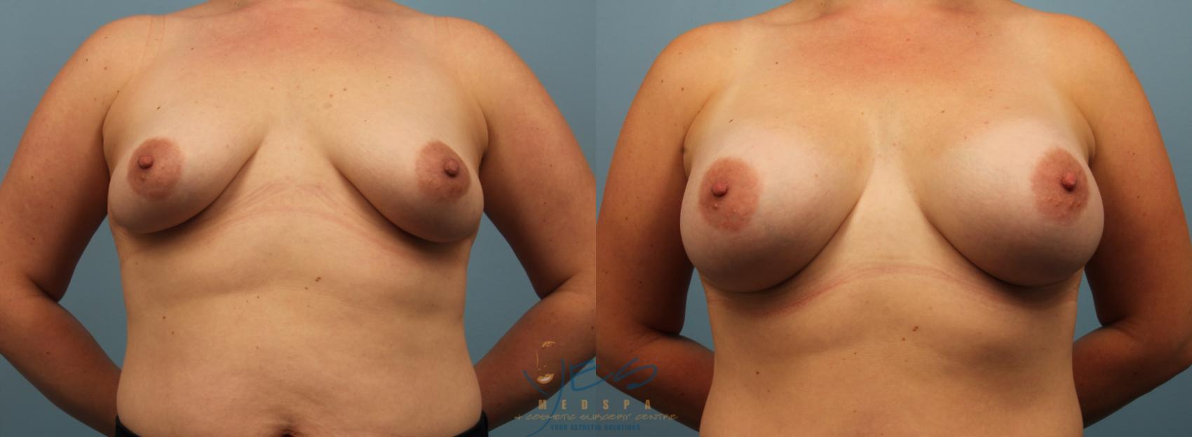 Before & After Breast Augmentation Case 351 Front View in Vancouver, BC