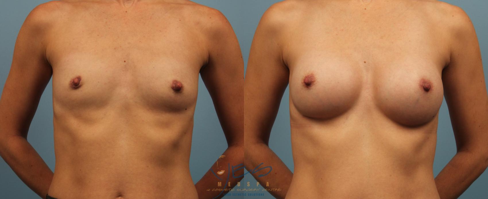Before & After Breast Augmentation Case 352 Front View in Vancouver, BC