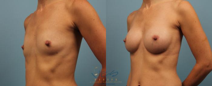 Before & After Breast Augmentation Case 352 Left Oblique View in Vancouver, BC