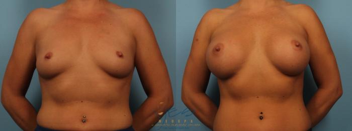 Before & After Breast Augmentation Case 373 Front View in Vancouver, BC