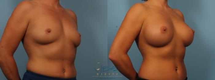 Before & After Breast Augmentation Case 373 Right Oblique View in Vancouver, BC