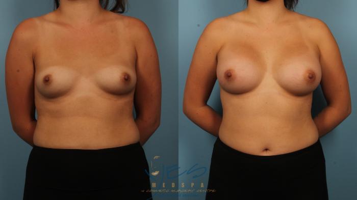 Before & After Breast Augmentation Case 376 Front View in Vancouver, BC