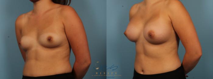 Before & After Breast Augmentation Case 376 Left Oblique View in Vancouver, BC
