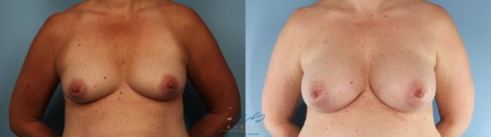 Before & After Breast Augmentation Case 378 Front View in Vancouver, BC