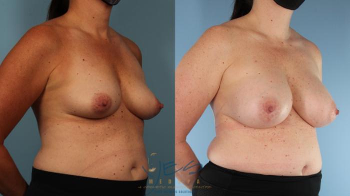 Before & After Breast Augmentation Case 378 Right Oblique View in Vancouver, BC