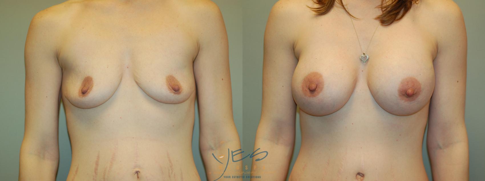 Before & After Breast Augmentation Case 4 Front View in Vancouver, BC