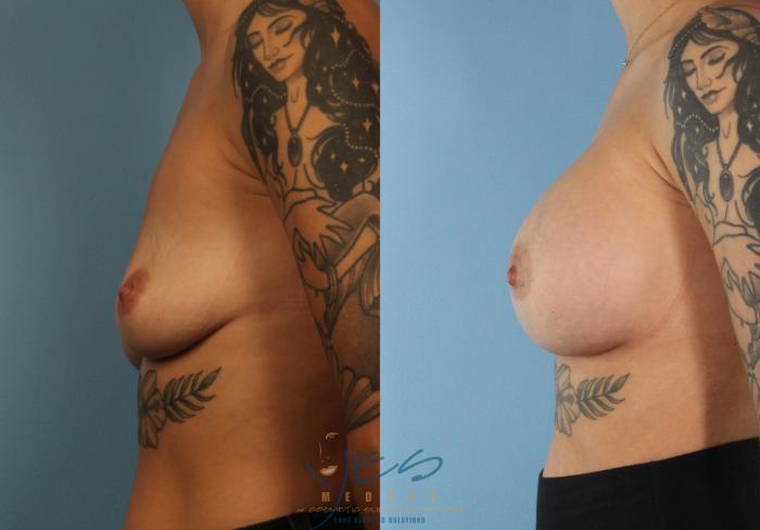 Before & After Breast Augmentation Case 446 Left Side View in Vancouver, BC