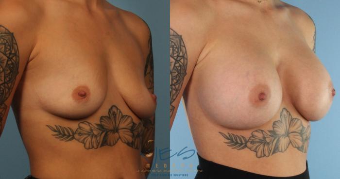 Before & After Breast Augmentation Case 446 Right Oblique View in Vancouver, BC