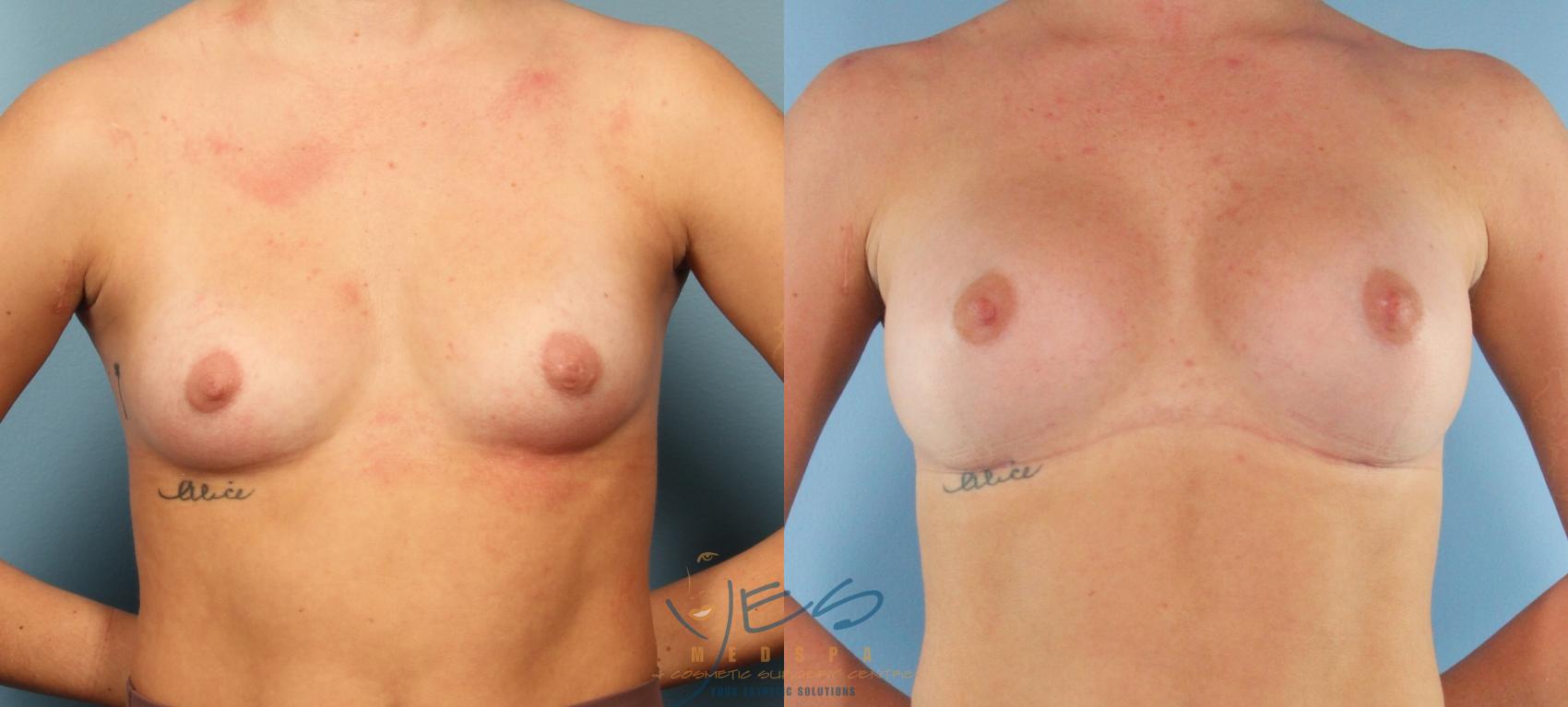 Before & After Breast Augmentation Case 448 Front View in Vancouver, BC