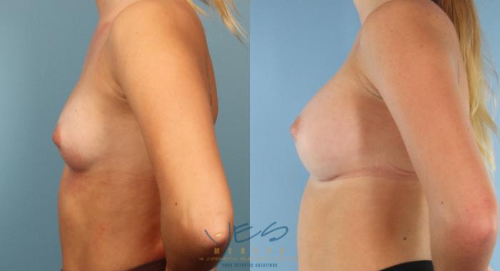 Before & After Breast Augmentation Case 448 Left Side View in Vancouver, BC