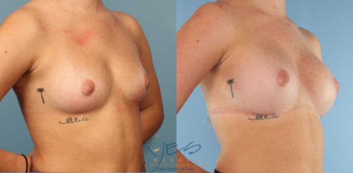 Before & After Breast Augmentation Case 448 Right Oblique View in Vancouver, BC