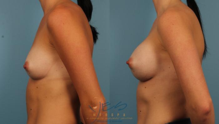 Before & After Breast Augmentation Case 449 Left Side View in Vancouver, BC