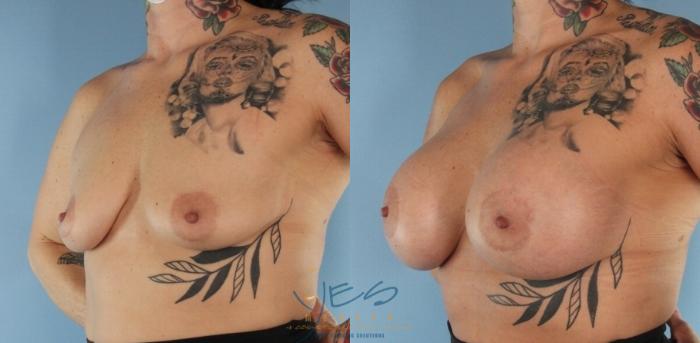 Before & After Breast Augmentation Case 451 Left Oblique View in Vancouver, BC