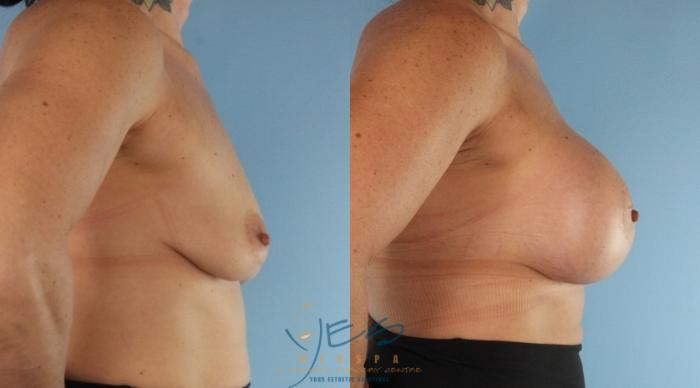 Before & After Breast Augmentation Case 451 Right Side View in Vancouver, BC