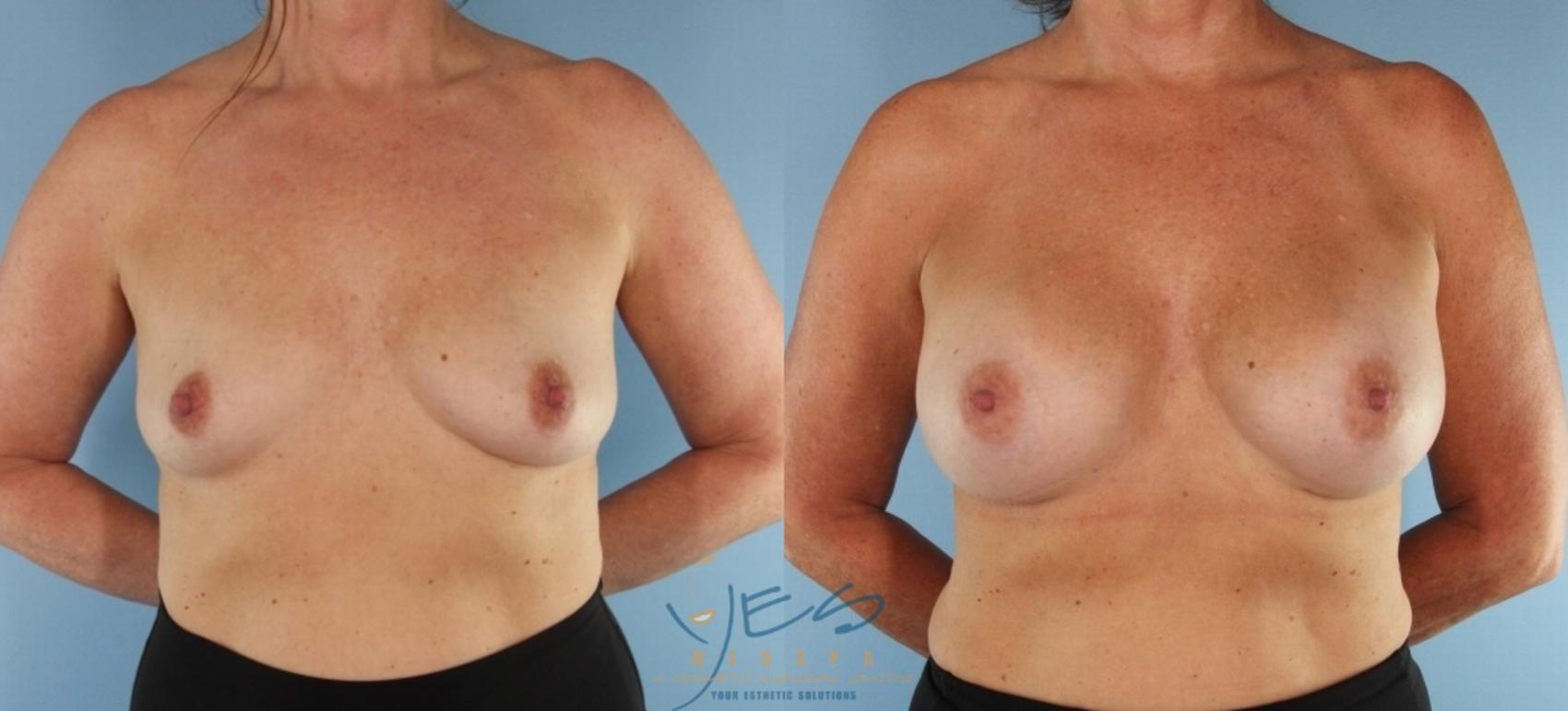 Before & After Breast Augmentation Case 454 Front View in Vancouver, BC
