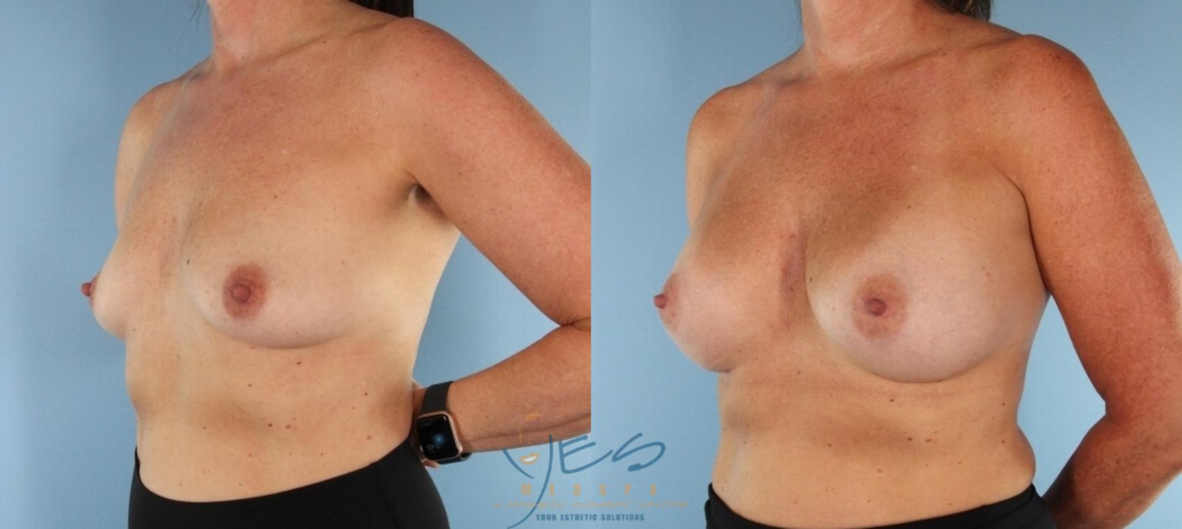 Before & After Breast Augmentation Case 454 Left Oblique View in Vancouver, BC