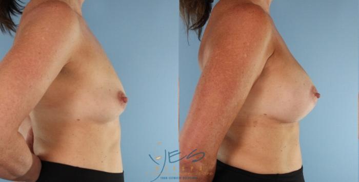 Before & After Breast Augmentation Case 454 Right Side View in Vancouver, BC