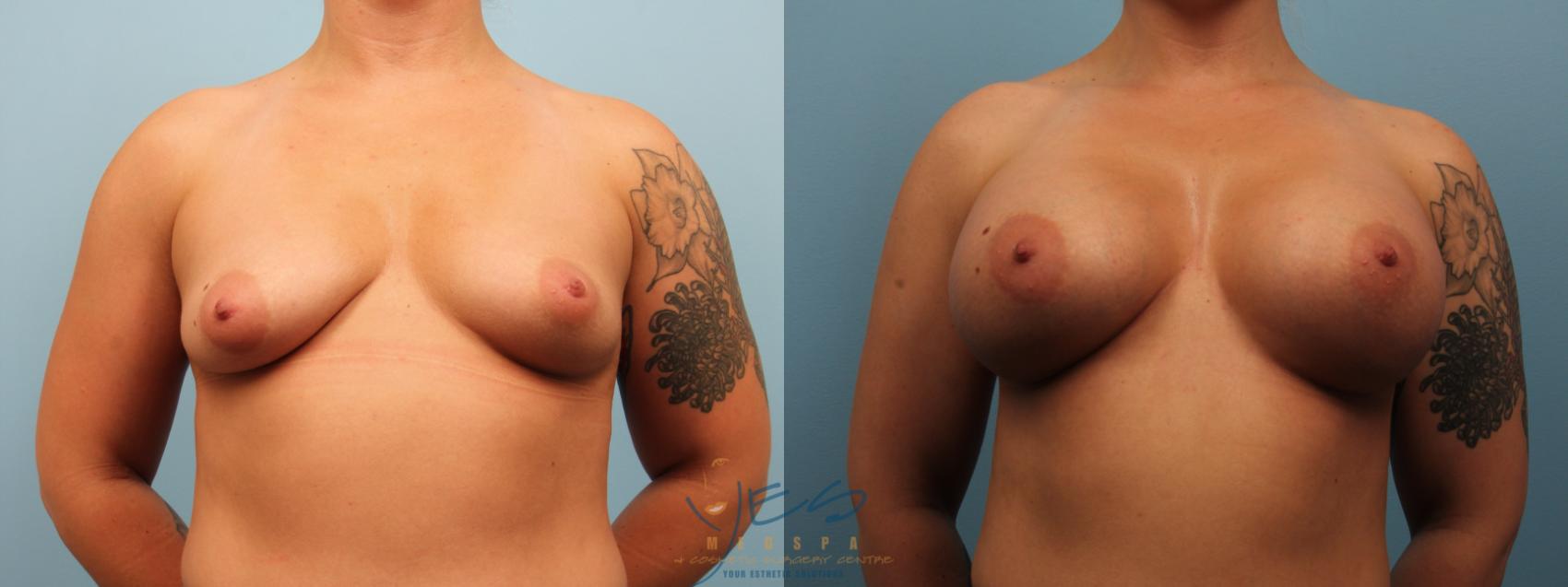 Before & After Breast Augmentation Case 472 Front View in Vancouver, BC