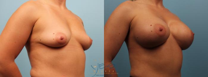 Before & After Breast Augmentation Case 472 Right Oblique View in Vancouver, BC