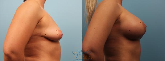 Before & After Breast Augmentation Case 472 Right Side View in Vancouver, BC