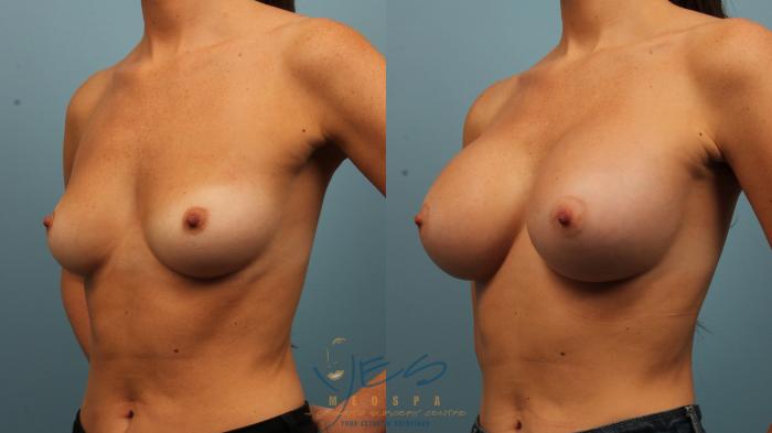 Before & After Breast Augmentation Case 474 Left Oblique View in Vancouver, BC