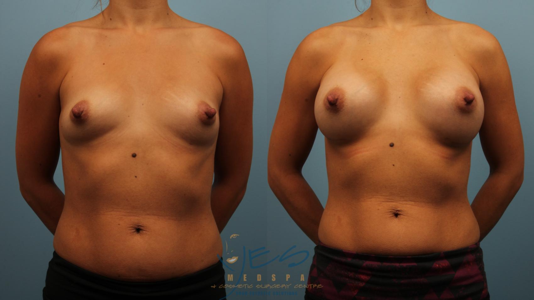 Before & After Breast Augmentation Case 476 Front View in Vancouver, BC