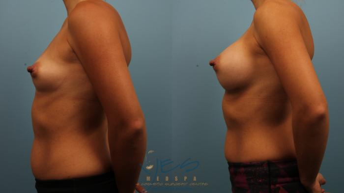 Before & After Breast Augmentation Case 476 Left Side View in Vancouver, BC