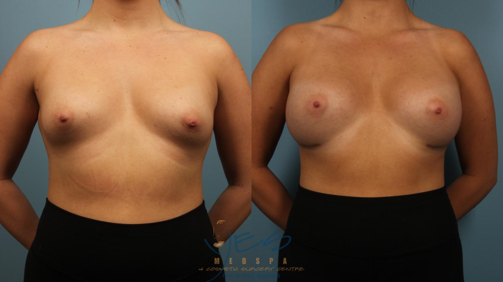 Before & After Breast Augmentation Case 477 Front View in Vancouver, BC